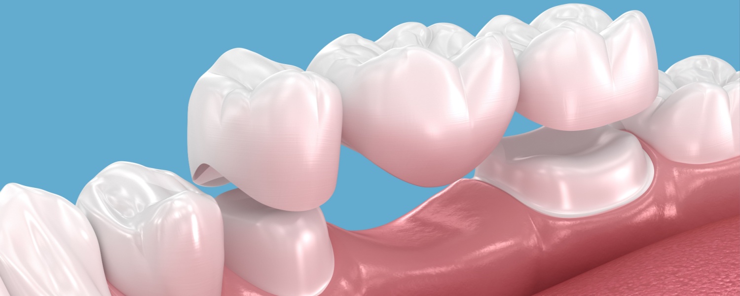 Dental Bridges 1 Dental Bridges in Bloomington, IL