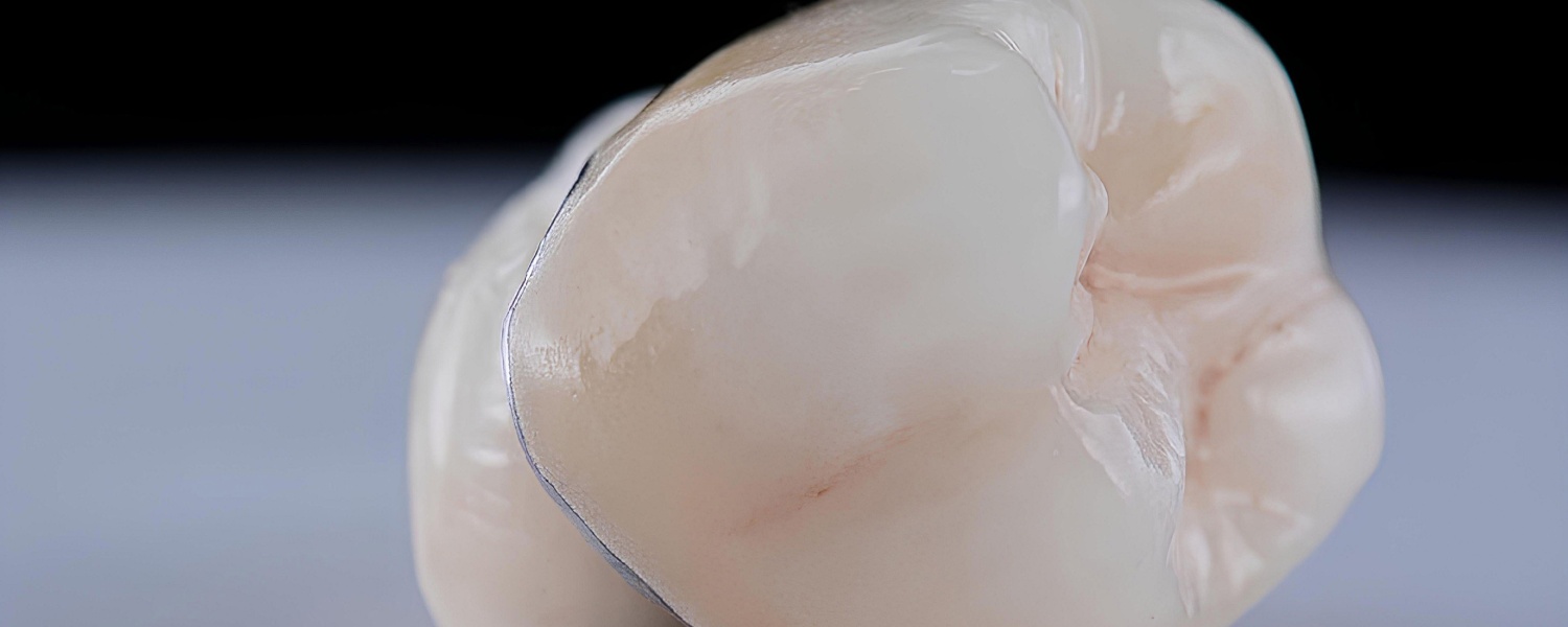 Dental Crowns in Bloomington, IL
