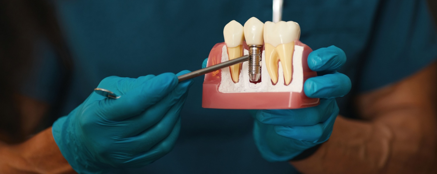 Dental Implants 1 Dental Implants in Bloomington, IL